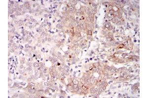 Immunohistochemical analysis of paraffin-embedded human cervical cancer tissues using BLNK mouse mAb with DAB staining.