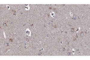 ABIN6276680 at 1/100 staining Human brain cancer tissue by IHC-P. (TLR3 Antikörper  (C-Term))