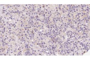 ABIN6273124 at 1/100 staining Human lymph cancer tissue by IHC-P. (HOMER1 Antikörper  (Internal Region))