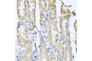Immunohistochemistry of paraffin-embedded human gastric cancer using CCL3 antibody (ABIN5974742) at dilution of 1/100 (40x lens). (CCL3 Antikörper)