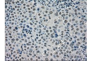 Immunohistochemical staining of paraffin-embedded Adenocarcinoma of ovary tissue using anti-SATB1mouse monoclonal antibody. (SATB1 Antikörper)