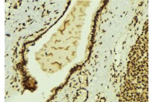 ABIN6269400 at 1/100 staining Human breast cancer tissue by IHC-P. (HDAC6 Antikörper  (N-Term))