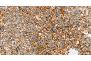 Immunohistochemistry of paraffin-embedded Human breast cancer tissue using SPARCL1 Polyclonal Antibody at dilution 1:30 (SPARCL1 Antikörper)
