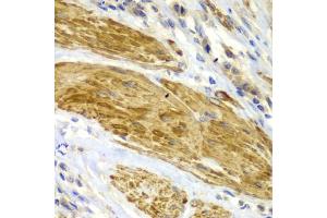 Immunohistochemistry of paraffin-embedded human gastric cancer using CDK6 antibody. (CDK6 Antikörper)