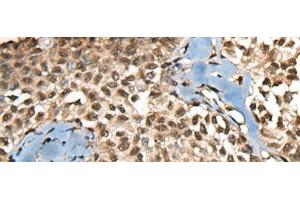 Immunohistochemistry of paraffin-embedded Human ovarian cancer tissue using CCDC12 Polyclonal Antibody at dilution of 1:60(x200)