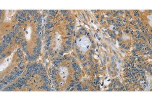 Immunohistochemistry of paraffin-embedded Human colon cancer tissue using DGK zeta Polyclonal Antibody at dilution 1:60