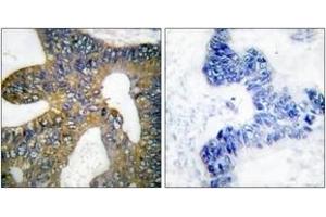 Immunohistochemistry analysis of paraffin-embedded human colon carcinoma tissue, using HSP105 Antibody. (HSPH1 Antikörper  (AA 791-840))