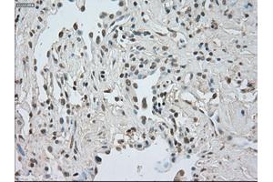 Immunohistochemical staining of paraffin-embedded Adenocarcinoma of breast tissue using anti-CTAG1B mouse monoclonal antibody. (CTAG1B Antikörper)