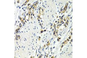 Immunohistochemistry of paraffin-embedded human gastric cancer using WNT3A antibody (ABIN6292349) at dilution of 1:200 (40x lens). (WNT3A Antikörper)