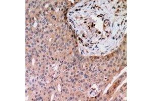 Immunohistochemical analysis of RAB24 staining in human breast cancer formalin fixed paraffin embedded tissue section. (RAB24 Antikörper)
