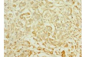Immunohistochemistry of paraffin-embedded human pancreatic cancer using ABIN7164617 at dilution of 1:100 (TTLL2 Antikörper  (AA 401-592))