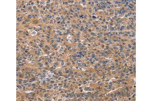 Immunohistochemistry of Human lung cancer using NCR2 Polyclonal Antibody at dilution of 1:60 (NKp44/NCR2 Antikörper)