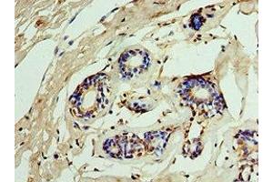 Immunohistochemistry of paraffin-embedded human breast cancer using ABIN7156290 at dilution of 1:100 (IMPDH2 Antikörper  (AA 215-514))