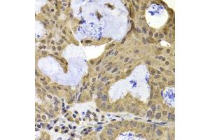 Immunohistochemistry of paraffin-embedded human oophoroma using TERF2IP antibody at dilution of 1:100 (40x lens). (RAP1 Antikörper)