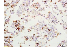 Formalin-fixed and paraffin embedded rat lung melanoma labeled with Anti-MAGE-1 Polyclonal Antibody, Unconjugated  at 1:200, followed by conjugation to the secondary antibody and DAB staining