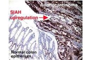 Immunohistochemical staining of SIAH2 on human colorectal adenocarcinoma with SIAH2 monoclonal antibody, clone 24E6H3 . (SIAH2 Antikörper  (AA 1-100))