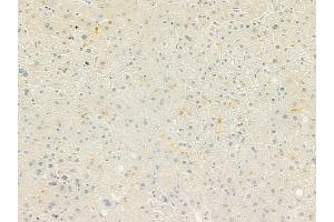 ABIN6260737 and ABIN6279257 at 1/100 staining human hepatocellular carcinoma by IHC-P. (CEACAM16 Antikörper  (Internal Region))