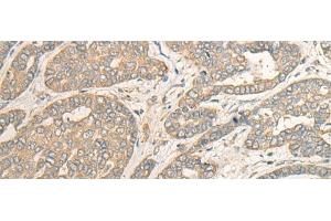 Immunohistochemistry of paraffin-embedded Human liver cancer tissue using MYOZ2 Polyclonal Antibody at dilution of 1:40(x200)
