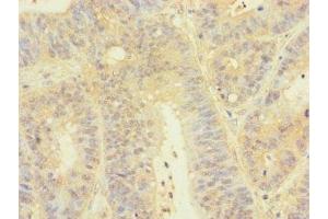 Immunohistochemistry of paraffin-embedded human colon cancer using ABIN7172830 at dilution of 1:100 (TGFB3 Antikörper  (AA 24-300))