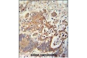 CHCHD2 antibody (Center) (ABIN654013 and ABIN2843939) immunohistochemistry analysis in formalin fixed and paraffin embedded human colon carcinoma followed by peroxidase conjugation of the secondary antibody and DAB staining. (CHCHD2 Antikörper  (AA 74-103))