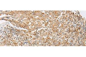 Immunohistochemistry of paraffin-embedded Human cervical cancer tissue using MBOAT4 Polyclonal Antibody at dilution of 1:30(x200)