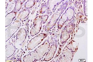 Formalin-fixed and paraffin embedded human gastric carcinoma tissue labeled with Anti-CENPA Polyclonal Antibody, Unconjugated (ABIN750113) at 1:200 followed by conjugation to the secondary antibody and DAB staining (CENPA Antikörper  (AA 65-140))
