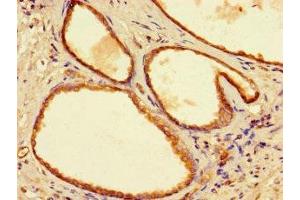 Immunohistochemistry of paraffin-embedded human prostate cancer using ABIN7166350 at dilution of 1:100 (YIPF6 Antikörper  (AA 2-84))