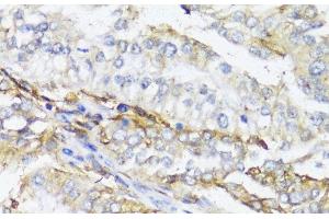 Immunohistochemistry of paraffin-embedded Human colon carcinoma using HLA-DPB1 Polyclonal Antibody at dilution of 1:100 (40x lens). (HLA-DPB1 Antikörper)