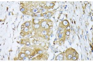 Immunohistochemistry of paraffin-embedded Human liver cancer using CALR Polyclonal Antibody at dilution of 1:100 (40x lens). (Calreticulin Antikörper)