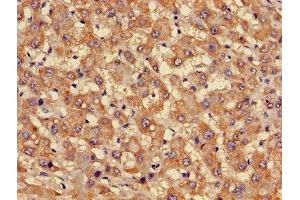 Immunohistochemistry of paraffin-embedded human liver cancer using ABIN7153167 at dilution of 1:100 (FFAR3 Antikörper  (AA 280-346))