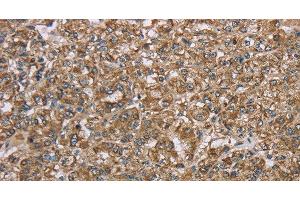 Immunohistochemistry of paraffin-embedded Human prostate cancer using CERS4 Polyclonal Antibody at dilution of 1:35 (LASS4 Antikörper)