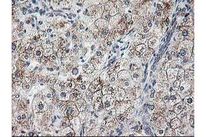 Immunohistochemical staining of paraffin-embedded Human liver tissue using anti-RPN1 mouse monoclonal antibody. (RPN1 Antikörper)