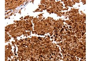 The image on the left is immunohistochemistry of paraffin-embedded Human lung cancer tissue using ABIN7128966(CLEC4A Antibody) at dilution 1/15, on the right is treated with fusion protein. (CLEC4A Antikörper)