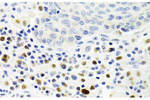 Immunohistochemistry of paraffin-embedded Human lung cancer using GEMIN2 Polyclonal Antibody at dilution of 1:100 (40x lens). (SIP1 Antikörper)