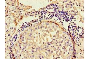Immunohistochemistry of paraffin-embedded human lung cancer using ABIN7144308 at dilution of 1:100 (Anoctamin 4 Antikörper  (AA 1-200))