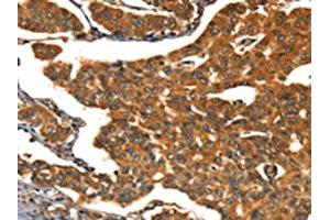 The image on the left is immunohistochemistry of paraffin-embedded Human breast cancer tissue using ABIN7190038(CACNA1E Antibody) at dilution 1/15, on the right is treated with synthetic peptide. (CACNA1E Antikörper)