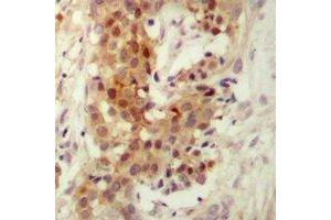 Immunohistochemical analysis of PKC iota/zeta staining in human breast cancer formalin fixed paraffin embedded tissue section. (PKC iota/zeta Antikörper)