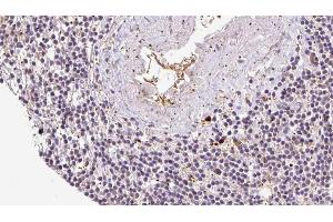 ABIN6273070 at 1/100 staining Human lymph cancer tissue by IHC-P.