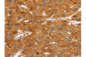 The image on the left is immunohistochemistry of paraffin-embedded Human liver cancer tissue using ABIN7130217(MED22 Antibody) at dilution 1/40, on the right is treated with fusion protein. (MED22 Antikörper)