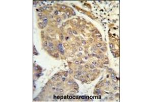 Formalin-fixed and paraffin-embedded human hepatocarcinoma reacted with PHACTR2 Antibody (N-term), which was peroxidase-conjugated to the secondary antibody, followed by DAB staining. (PHACTR2 Antikörper  (N-Term))