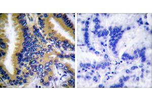 Peptide - +Immunohistochemical analysis of paraffin-embedded human breast carcinoma tissue using BIK (Ab-33) antibody (#B0053). (BIK Antikörper  (Thr33))