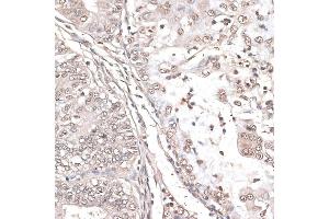 Immunohistochemistry of paraffin-embedded human endometrium cancer using MEF2C antibody (ABIN6132345, ABIN6143716, ABIN6143717 and ABIN6215998) at dilution of 1:100 (40x lens). (MEF2C Antikörper  (AA 170-380))