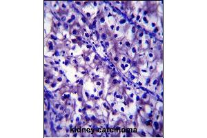 LB1 Antibody (C-term) (ABIN657904 and ABIN2846855) immunohistochemistry analysis in formalin fixed and paraffin embedded human kidney carcinoma followed by peroxidase conjugation of the secondary antibody and DAB staining.