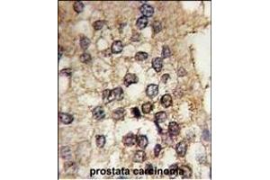 Formalin-fixed and paraffin-embedded human prostata carcinoma tissue reacted with CLOCK antibody (Center) (ABIN391842 and ABIN2841680) , which was peroxidase-conjugated to the secondary antibody, followed by DAB staining. (CLOCK Antikörper  (AA 215-249))