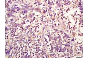 Formalin-fixed and paraffin embedded human lung carcinoma labeled with Anti-phospho-ERK1(Thr202/Tyr204) +ERK2(Thr183/Tyr185) Polyclonal Antibody, Unconjugated (ABIN732458) at 1:200 followed by conjugation to the secondary antibody and DAB staining
