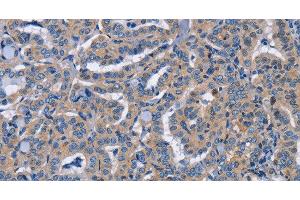 Immunohistochemistry of paraffin-embedded Human thyroid cancer tissue using NCR2 Polyclonal Antibody at dilution 1:60 (NKp44/NCR2 Antikörper)