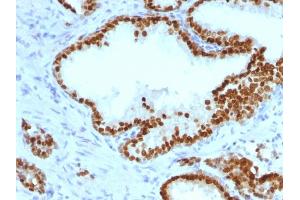 Formalin-fixed, paraffin-embedded human Prostate Carcinoma stained with FOXA1 Monoclonal Antibody (FOXA1/1241). (FOXA1 Antikörper  (AA 372-472))