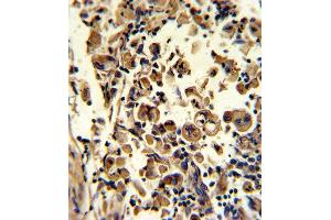 Formalin-fixed and paraffin-embedded human lung carcinoma reacted with SOD3 Antibody (N-term), which was peroxidase-conjugated to the secondary antibody, followed by DAB staining. (SOD3 Antikörper  (N-Term))