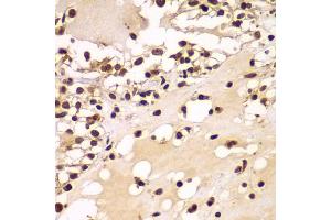 Immunohistochemistry of paraffin-embedded human kidney cancer using ZNF20 antibody (ABIN5975115) at dilution of 1/100 (40x lens). (ZNF20 Antikörper)