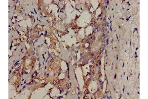 Immunohistochemistry analysis of human breast cancer using ABIN7174064 at dilution of 1:100 (SRMS Antikörper  (AA 19-155))